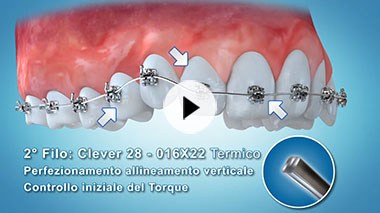 Clever Orthodontics Video n.1