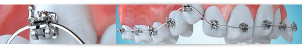 produzione-video-3d-allineamento-dentale