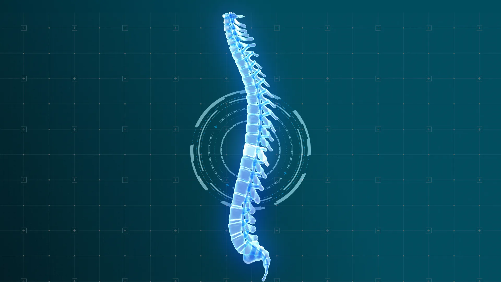 Video Animato 3D Ripristino Volume di una vertebra schiacciata