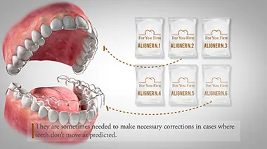 Video Guida Allineatori Ortodontici