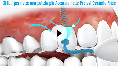 pulizia-protesi-dentarie