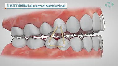 Elastici Intraorali
