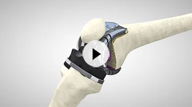 video-3d-protesi-ginocchio